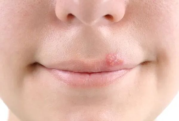 Cold sores on the lip