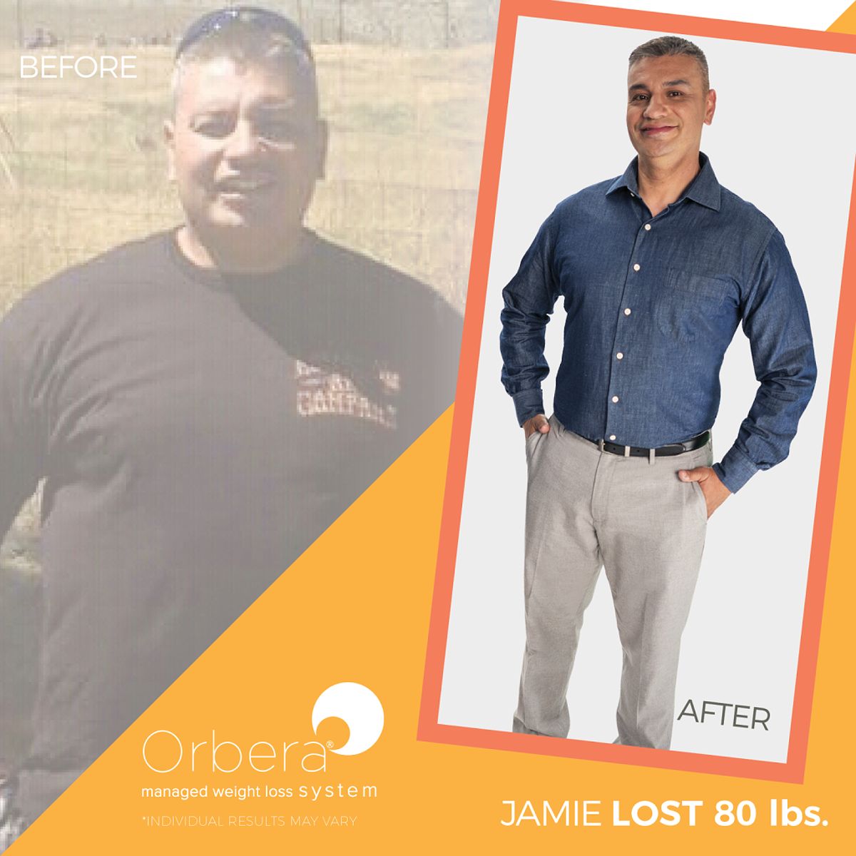 Jamie lost 80 lbs with the orbera gastric balloon