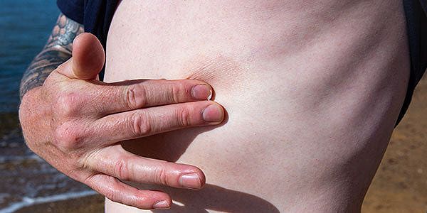 Man rubbing oil into patch of psoriasis on stomach